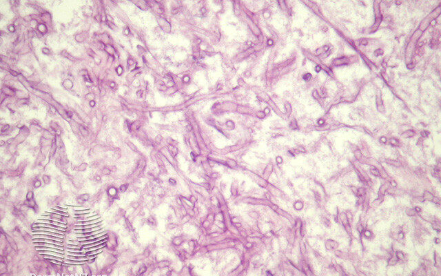 Mucormycosis